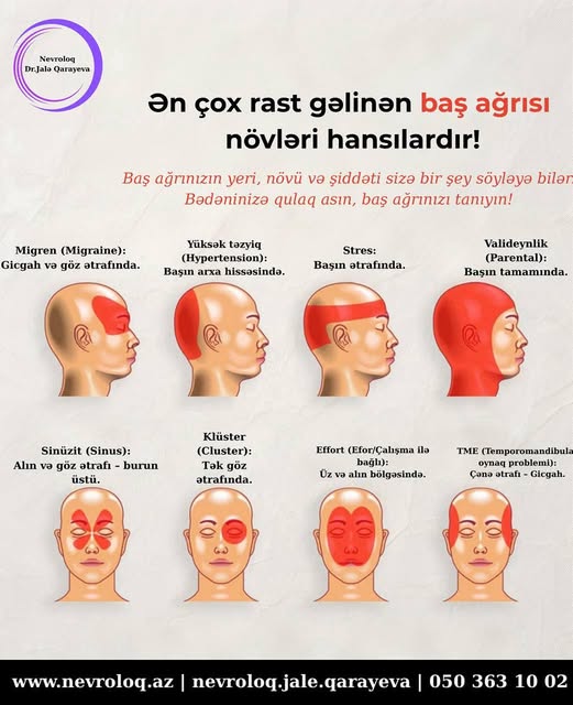 Hər baş ağrısı eyni deyil. Hər baş ağrısı eyni deyil.